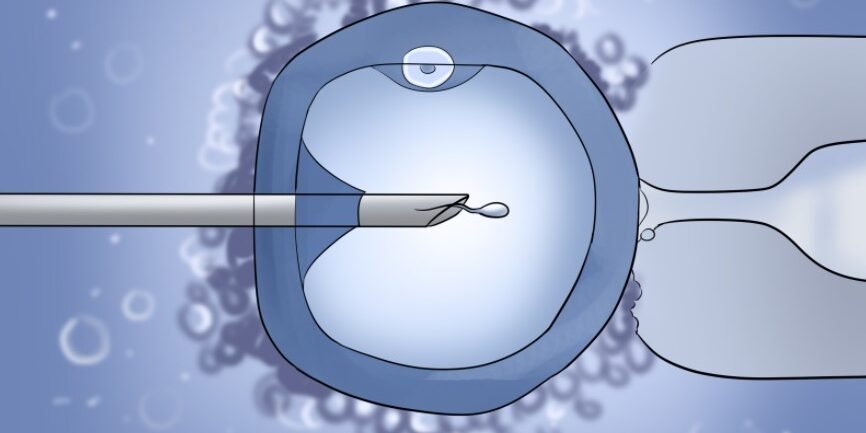 CSI procedure showing sperm injection into egg